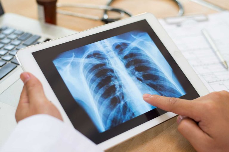 Australia’s new lung cancer screening program: What nurses need to know Australia’s new lung cancer screening program: What nurses need to know