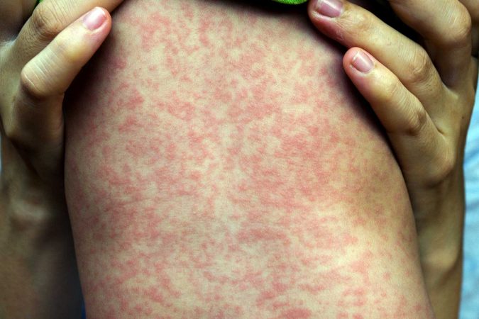 Beyond the rash: Nurses at the forefront of tackling the measles outbreak